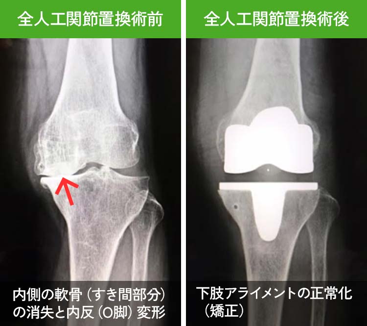 全人工関節置換手術前：内側の軟骨（すき間部分）の消失と内反（O脚）変形、全人工関節置換術後：下肢アライメントの正常化（矯正）