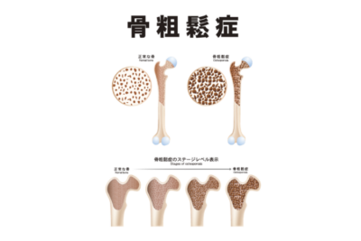 【骨粗しょう症】骨折を防ぐために今日からできることのアイキャッチ画像